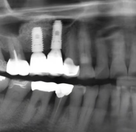 Implant placement on Lower Anterior