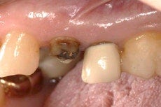 Immediate Implant Placement with Modified Palatal Roll