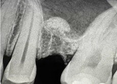 Intra-Crestal Sinus Lift and Bone Augmentation
